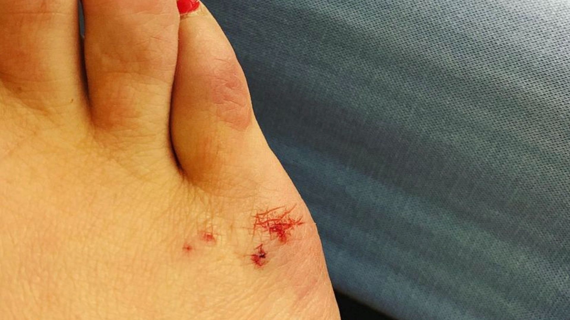 يمكن أن تشمل أعراض لدغات الفئران التورم والنزيف والألم. (الصورة من Instagram / libbykuts)